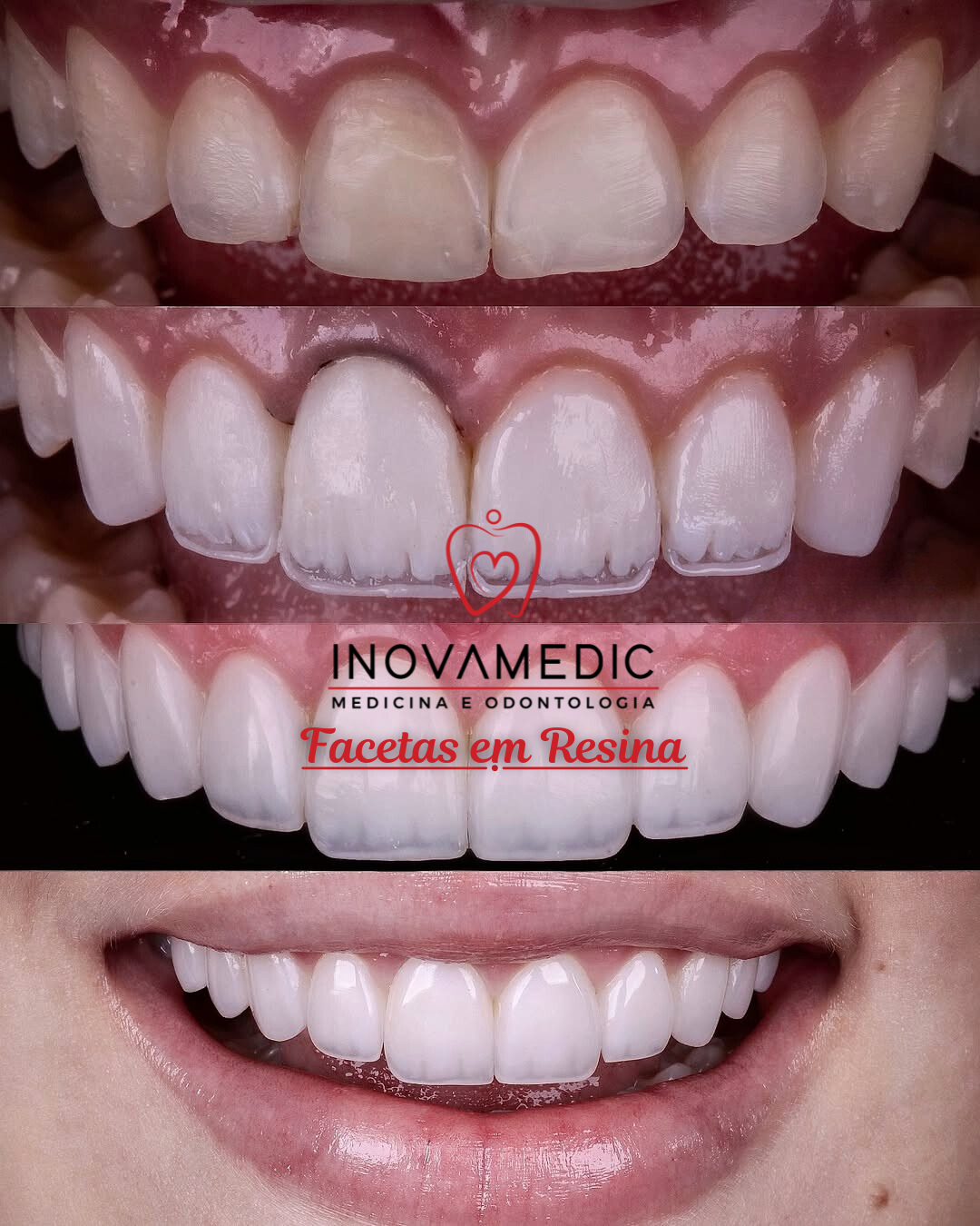 Clareamento dental — antes e depois